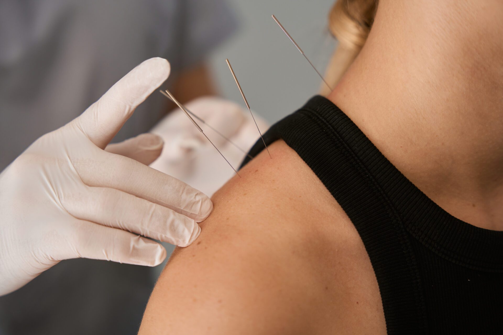 Reflexologist conducts an acupuncture session on a young woman You, Naturally Better